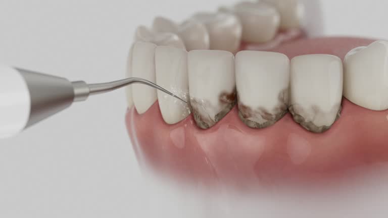 Trusted Wisdom Tooth Removal service in Hillsboro, IL - Dentist Open Now